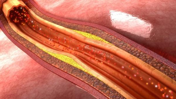 نانوذرات زنگ خطر ایجاد پلاک ها را پیش از حمله قلبی به صدا در می آورند